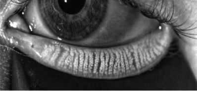 Trockenes Auge
